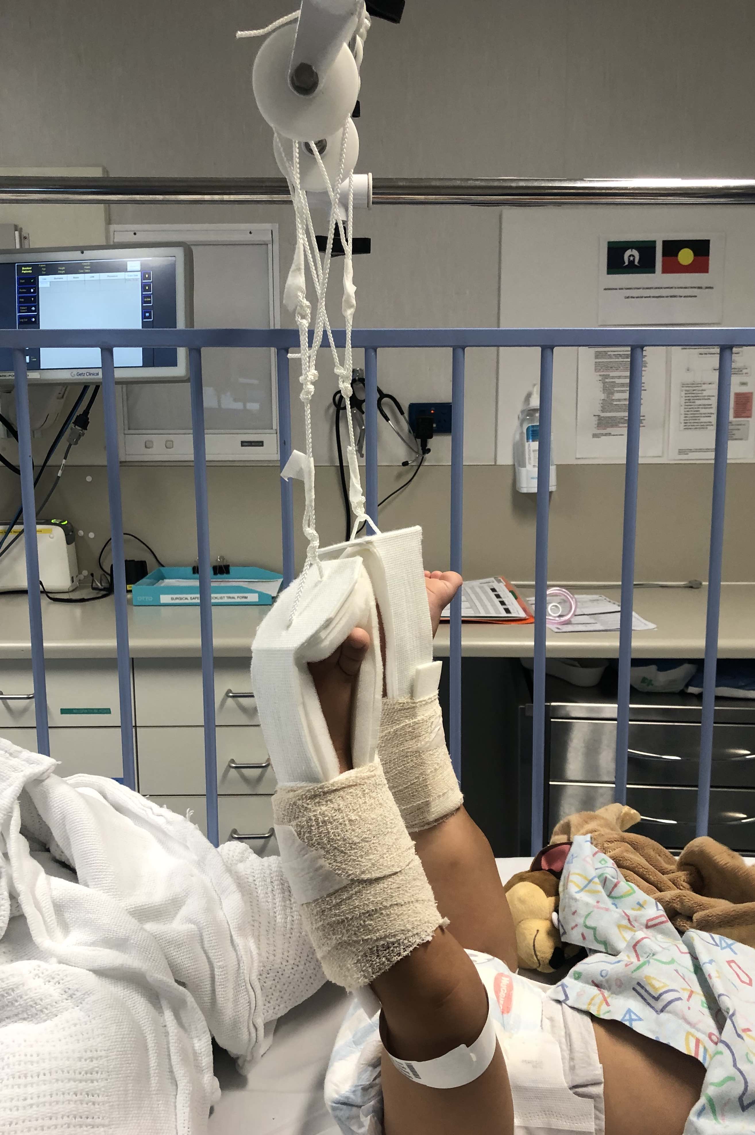 Femoral Fractures The Bone School